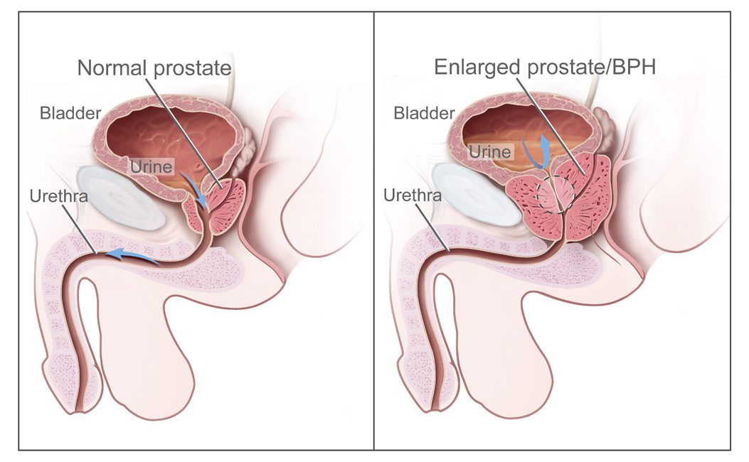 best treatment for benign prostatic hyperplasia in Trivandrum