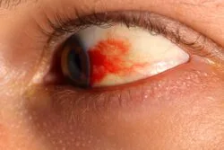 What can you do to prevent diabetic retinopathy